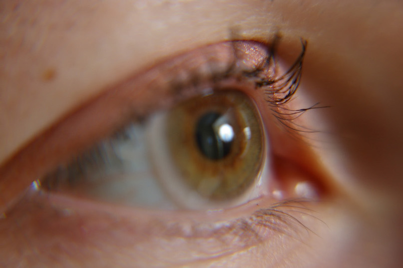 bezpieczna operacja zaćmy