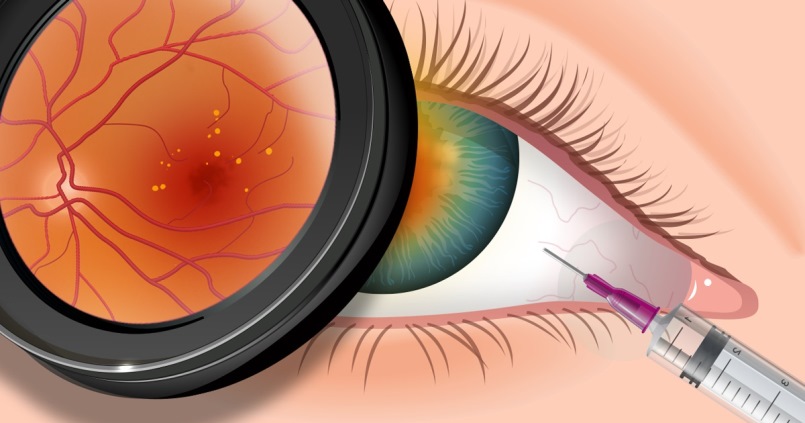 iniekcja doszklistkowa