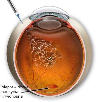 iniekcje-doszklistkowe
