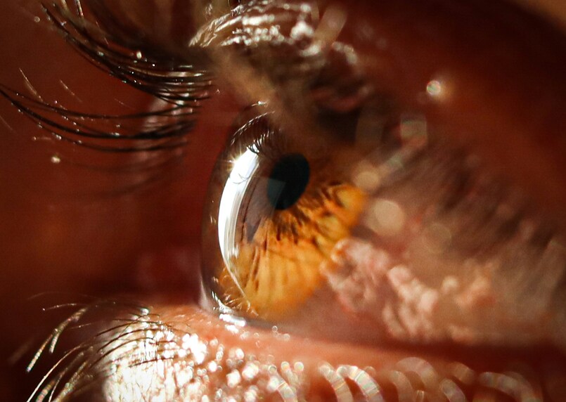 soczewki toryczne i sferyczne